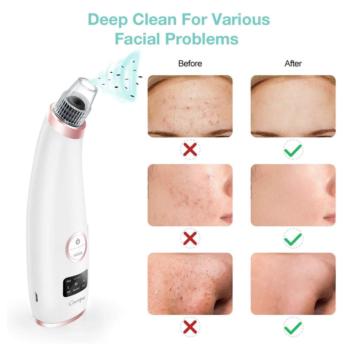 5-in-1 Blackhead & Spot Remover for Face Cleaning, Face Slimming with Multifunction